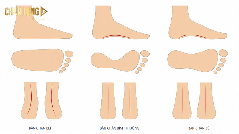 3 loại dáng bàn chân
